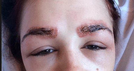 Nickel reaction and allergy to microblading