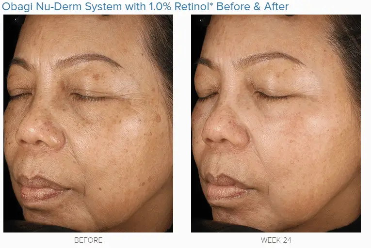 Retin A Cream Before And After Wrinkles