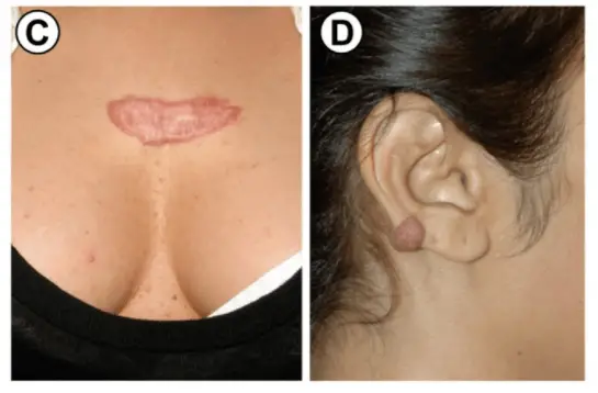 example of keloid formation on the skin